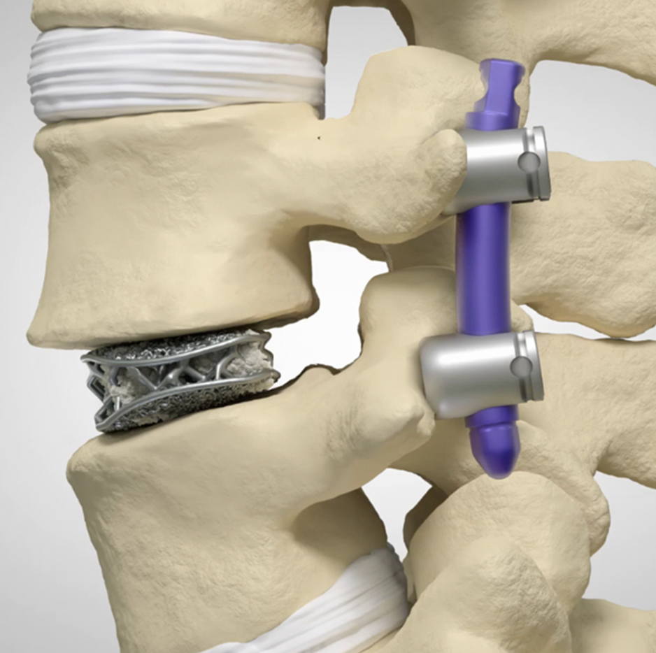 Импланты для хирургии позвоночника